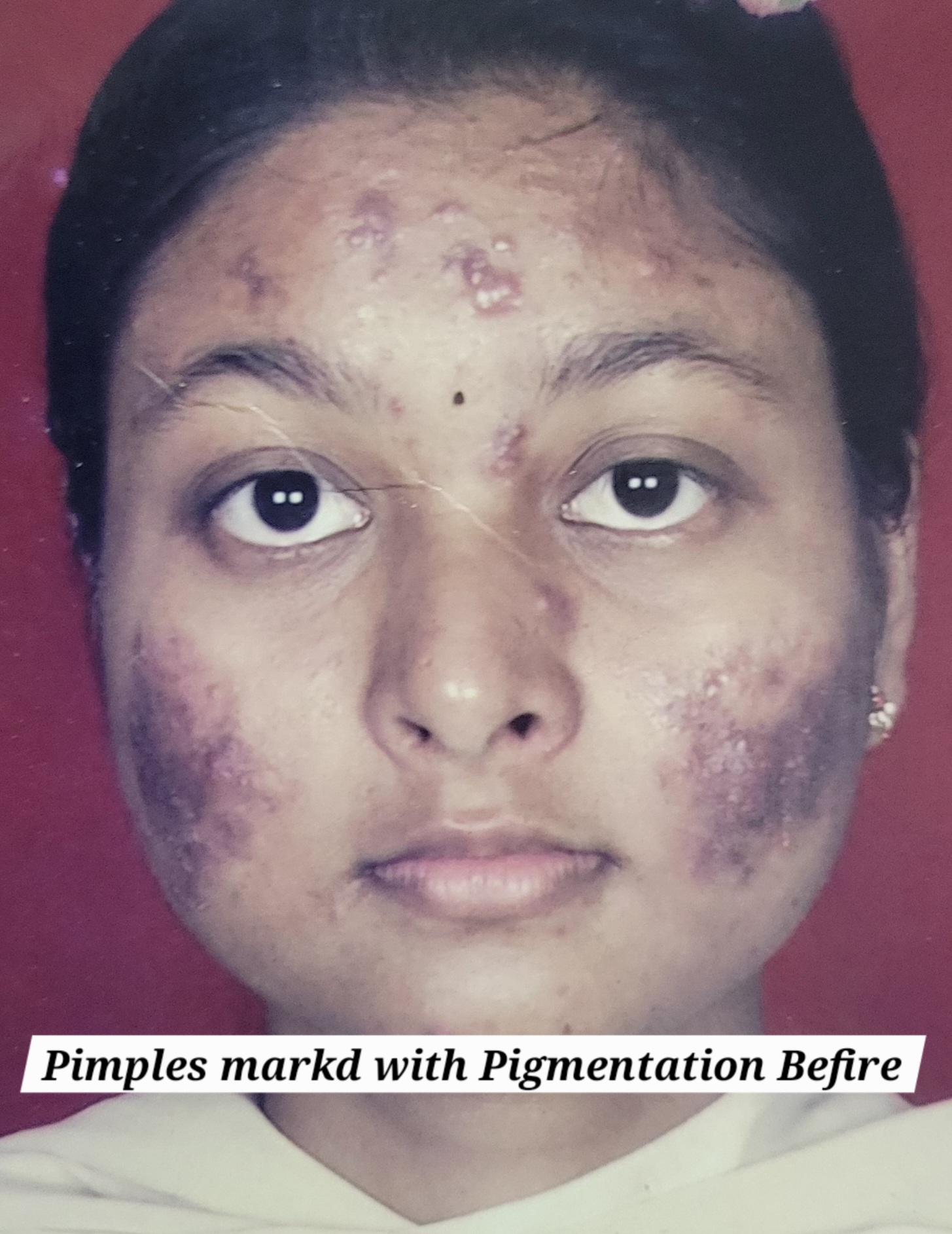 Acne and Pigmentation before