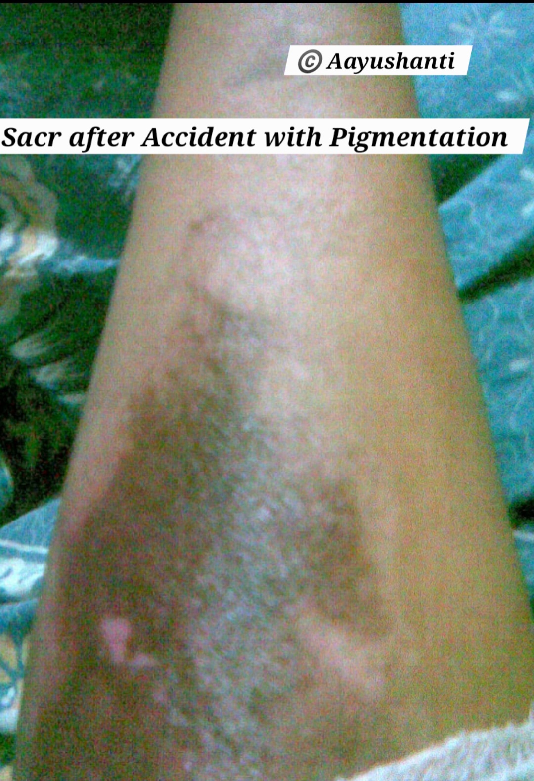 After Accident mark