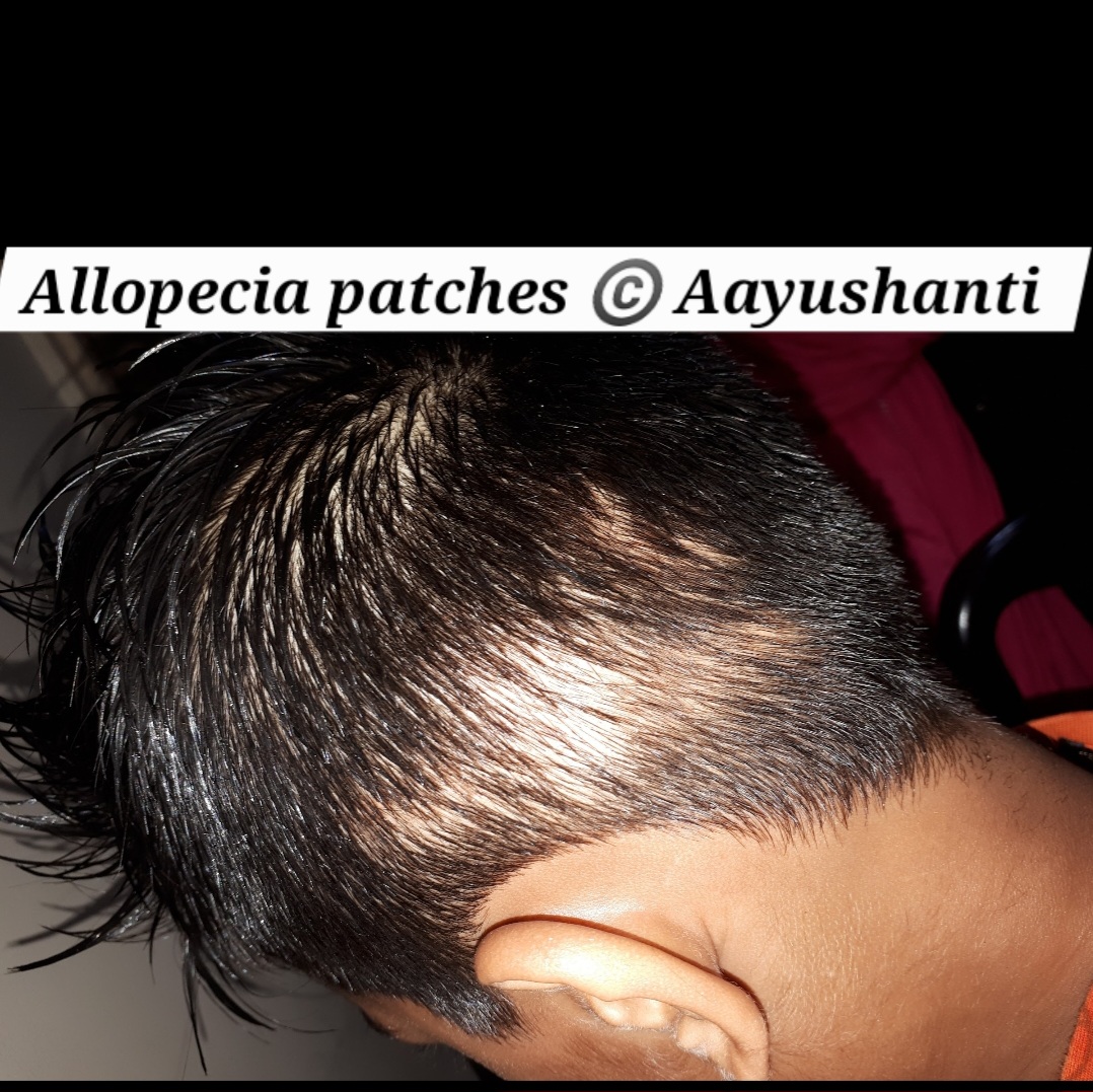 Allopecia 1