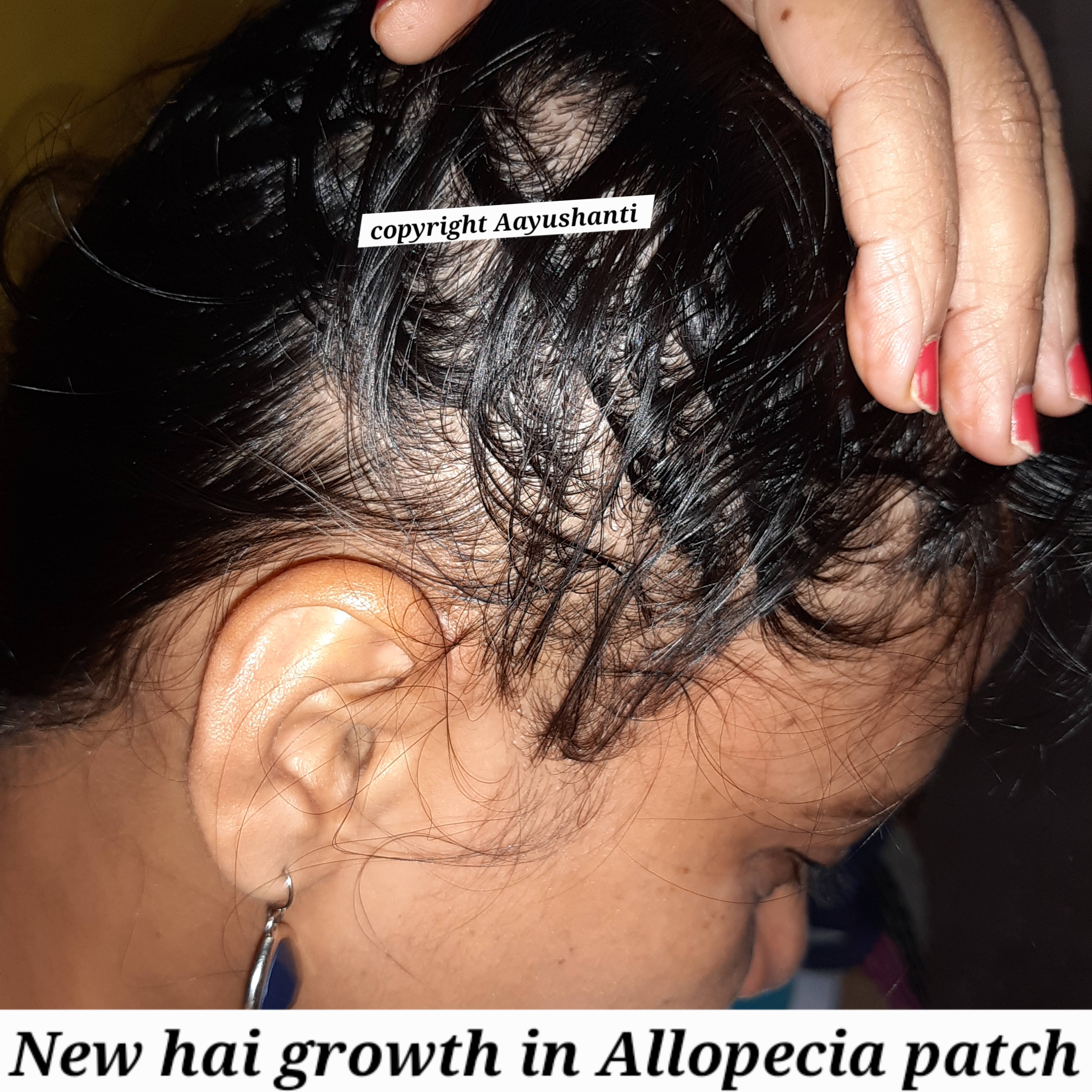 Allopecia New hair growth (1)