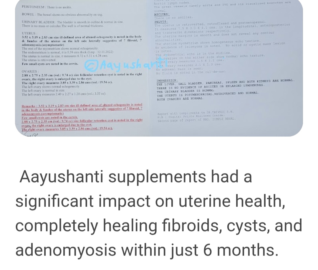 Fibroid cyst adenomyosis (1)