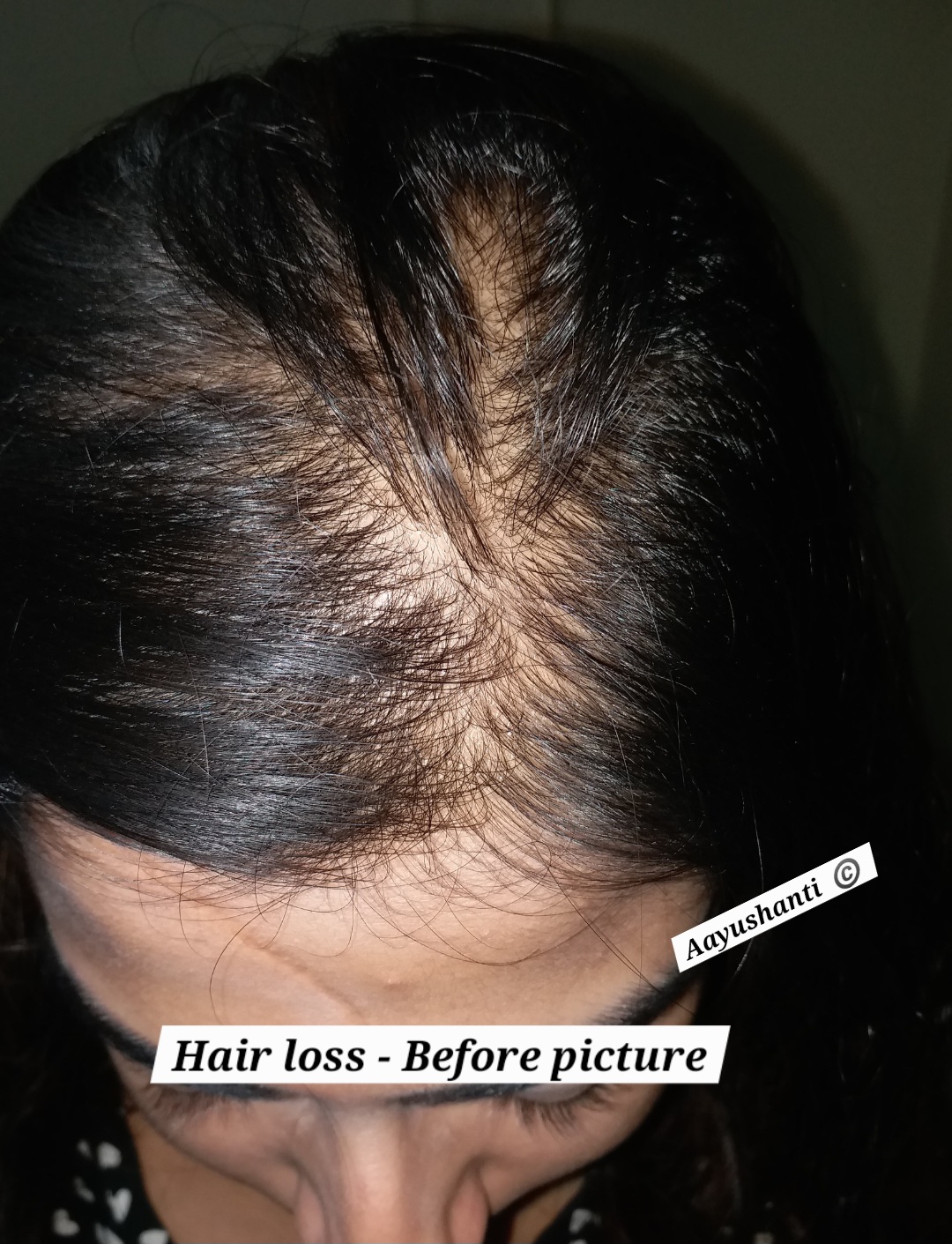 Hairfall 1