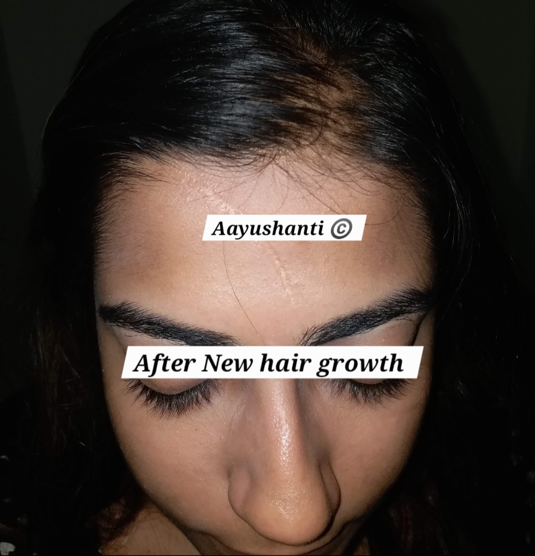 Hairfall 2