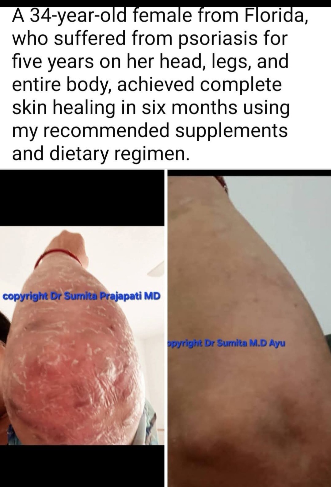 Psoriasis healed