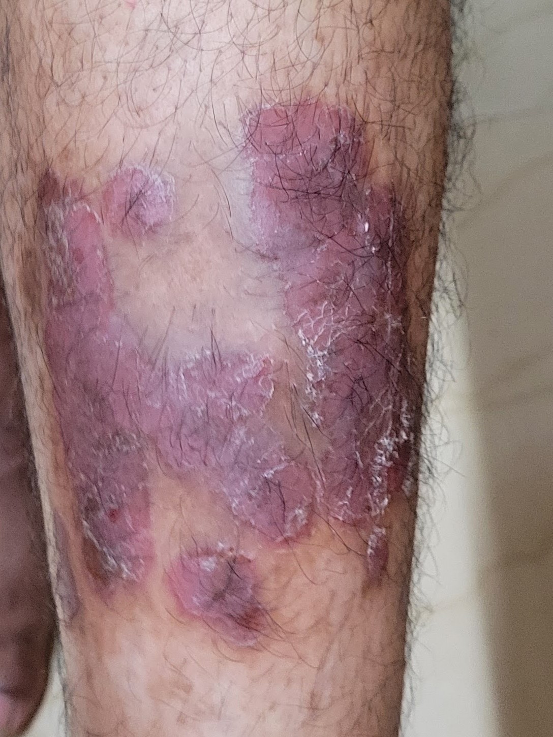 Psorisis 1 before 2 months