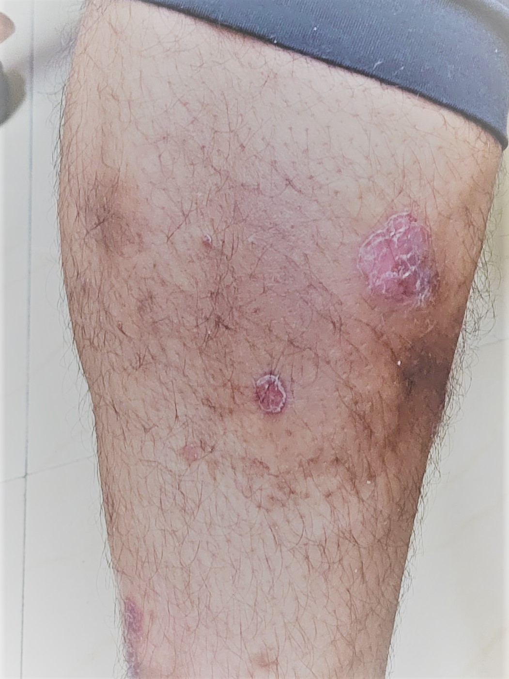 Psorisis 2 healed in 2 months