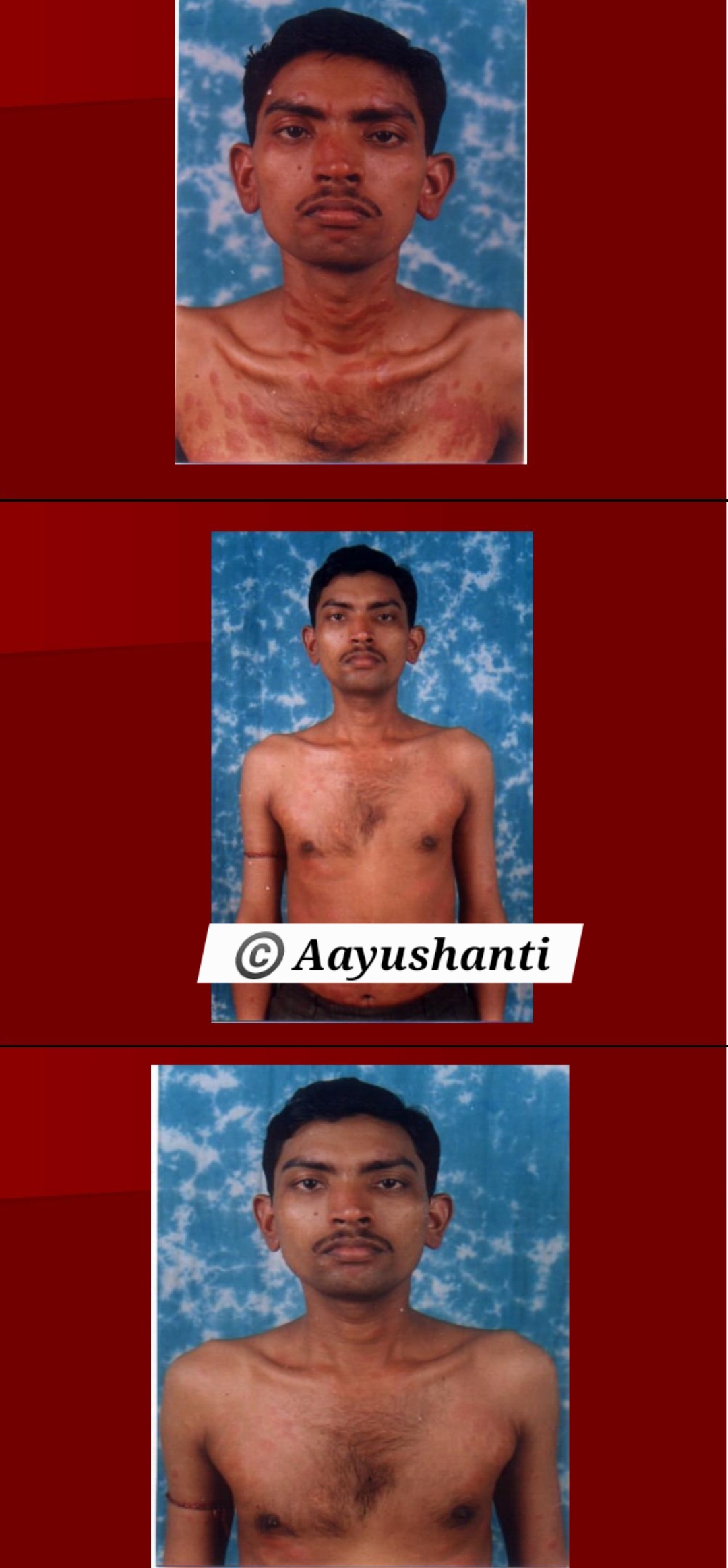Psorisis Before full body (2)
