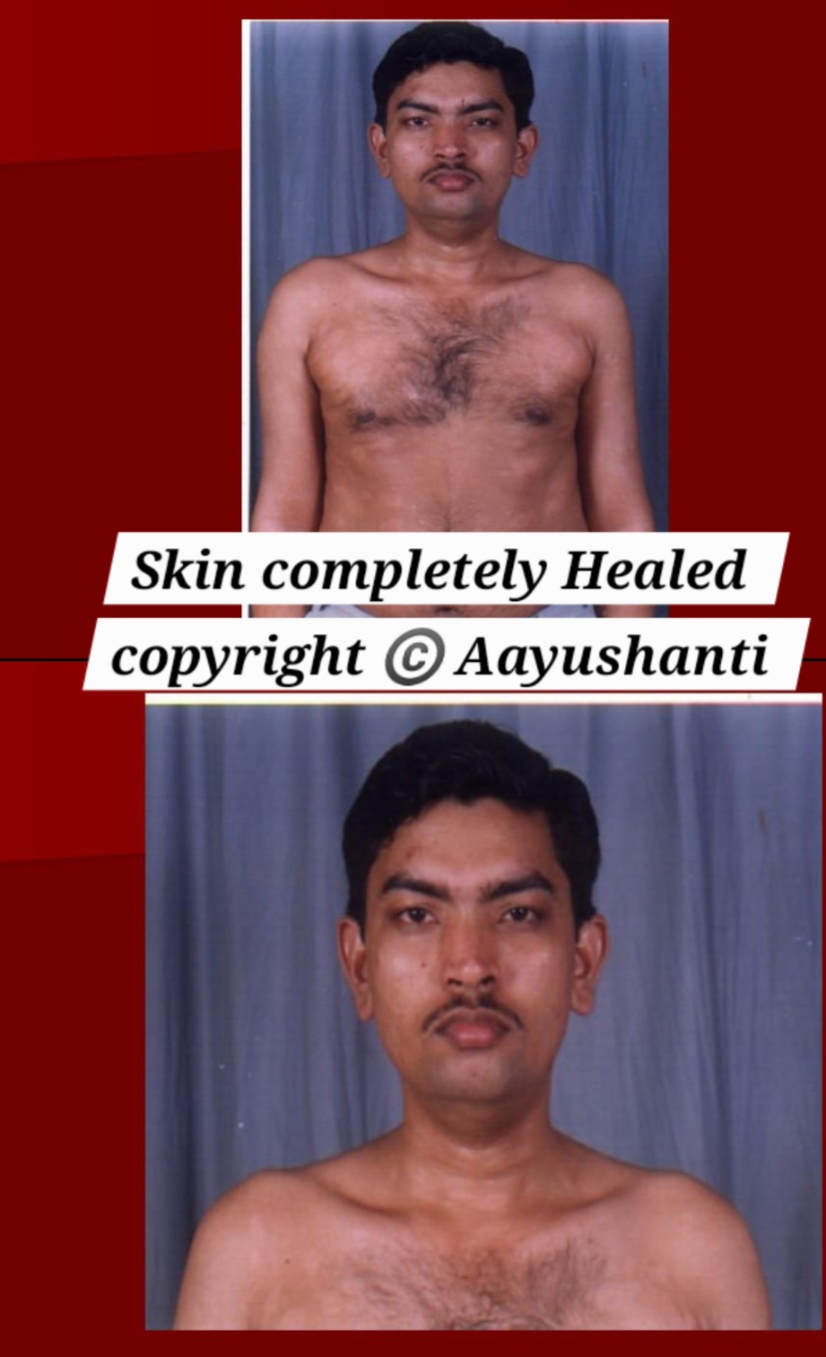 Psorisis completely healed (2)