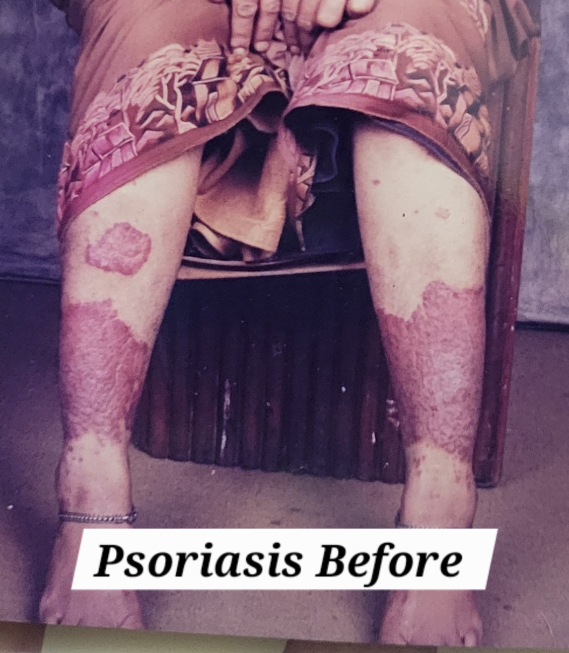 Psorisis in legs
