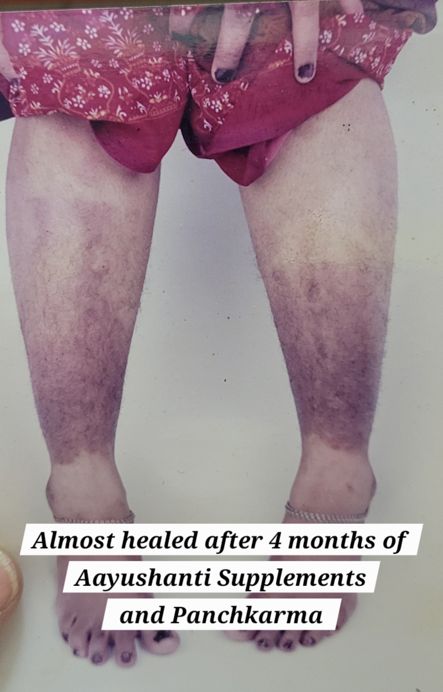 Psorisis legs healed