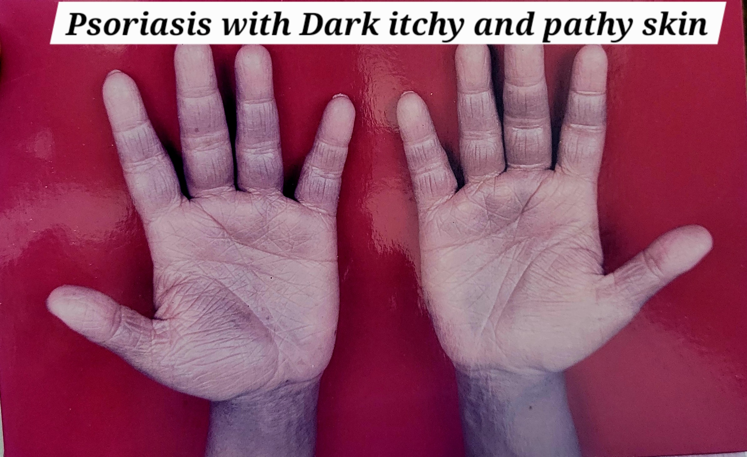 Psorisis of Palm before