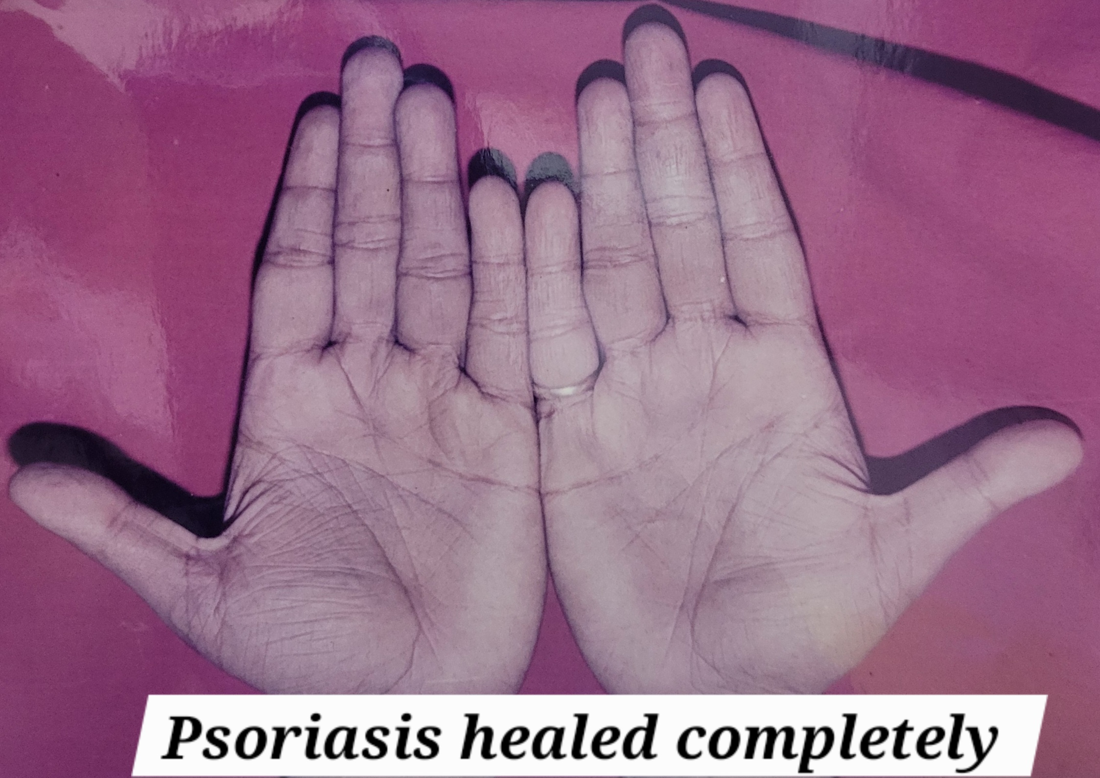 Psorisis of Palm healed