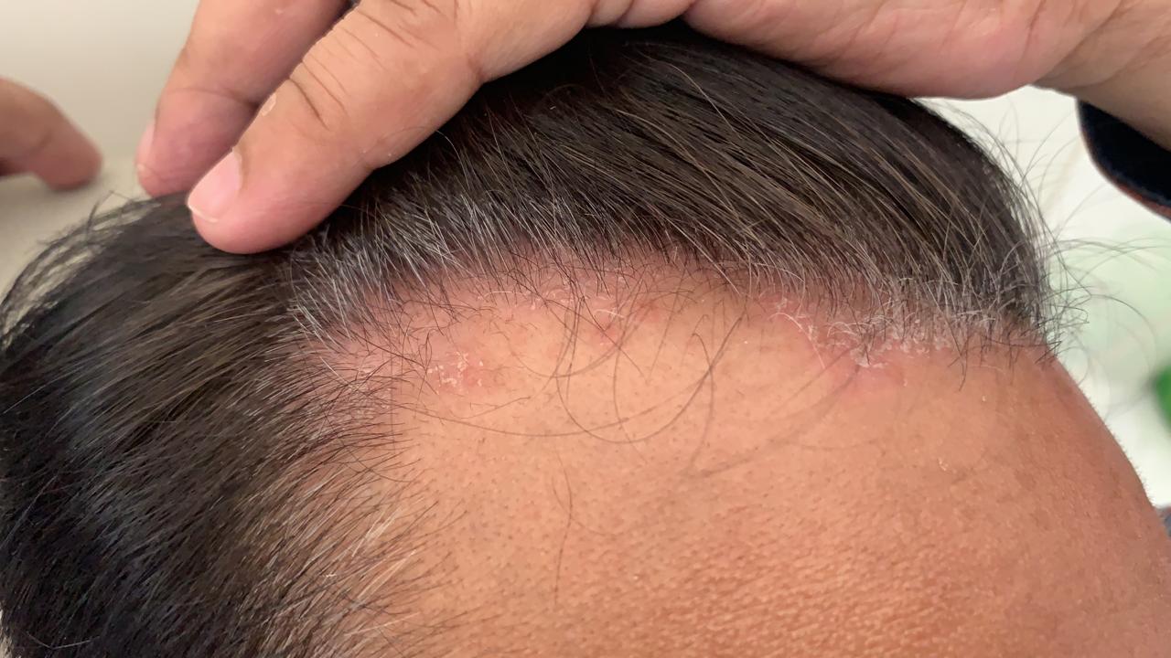 Psorisis scalp before 6 months