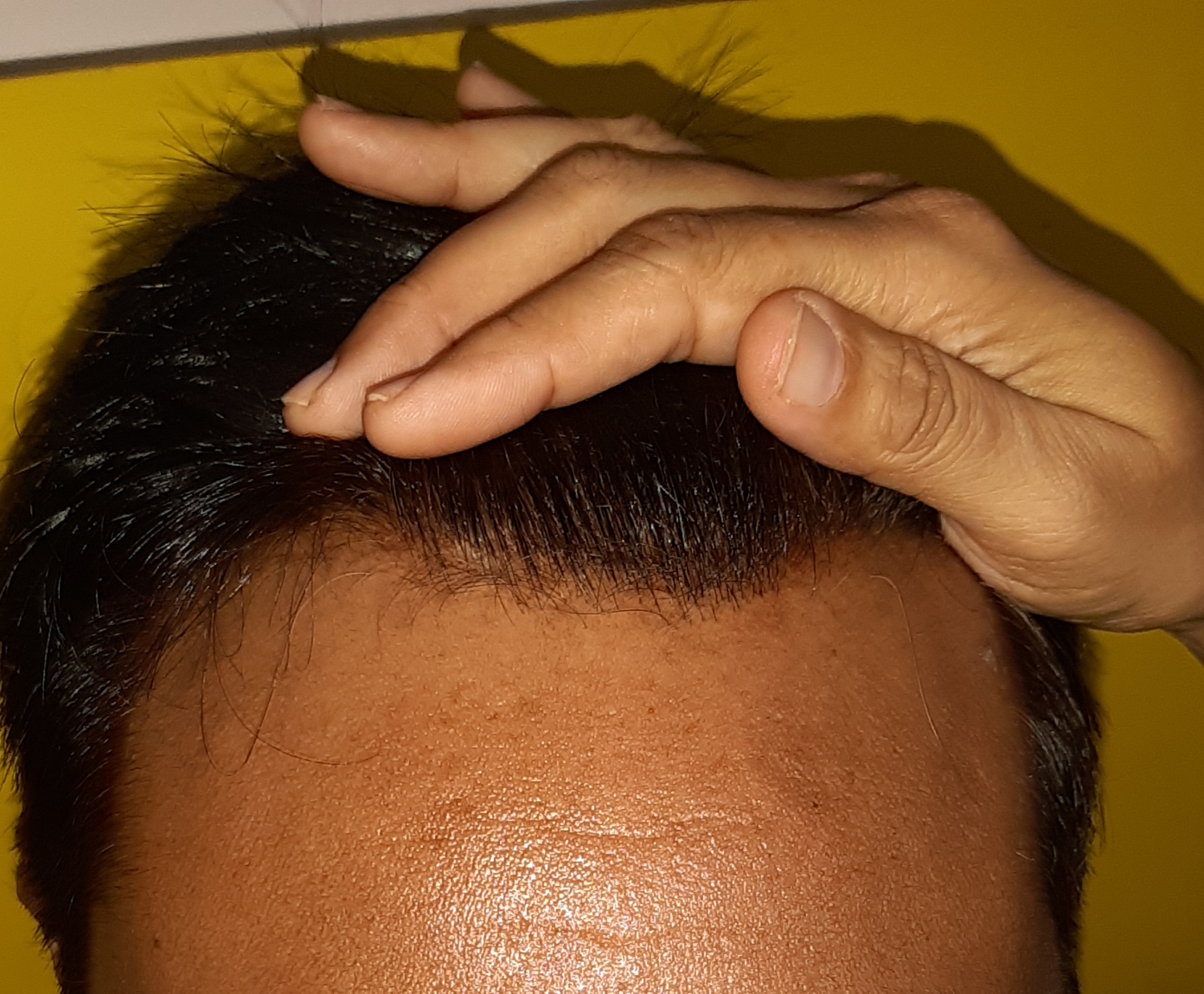 Psorisis scalp healed