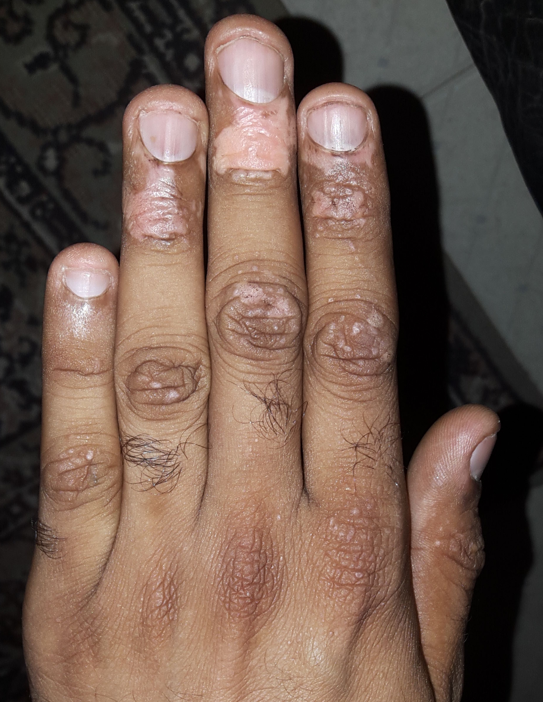 Vitilligo fingers before starting supplements