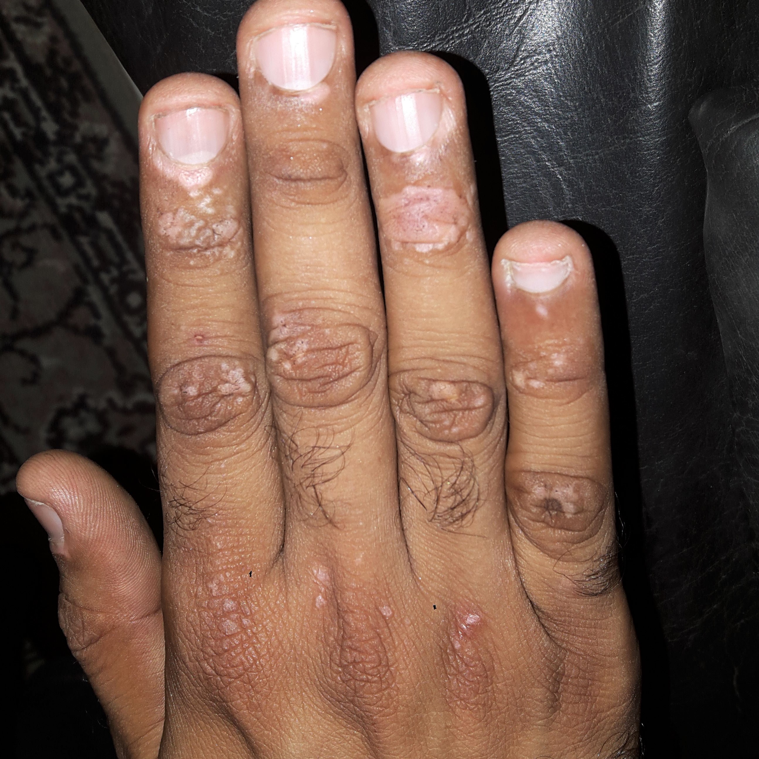 Vitilligo middle finger improved in 6 months