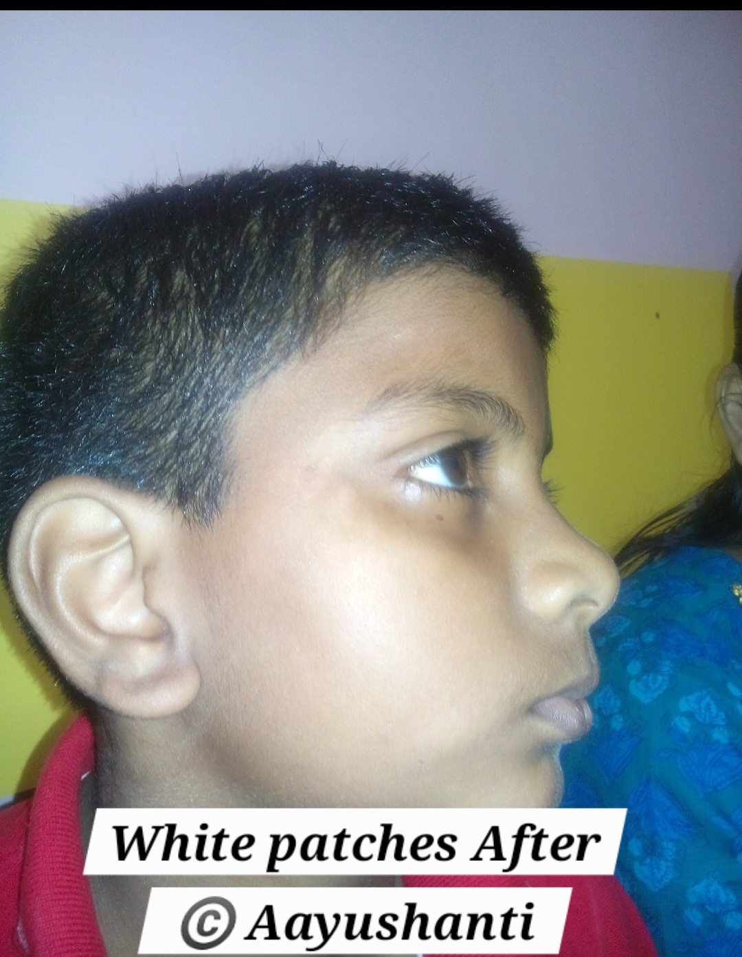 White Patches Healed with Aayushanti Supplements (2)