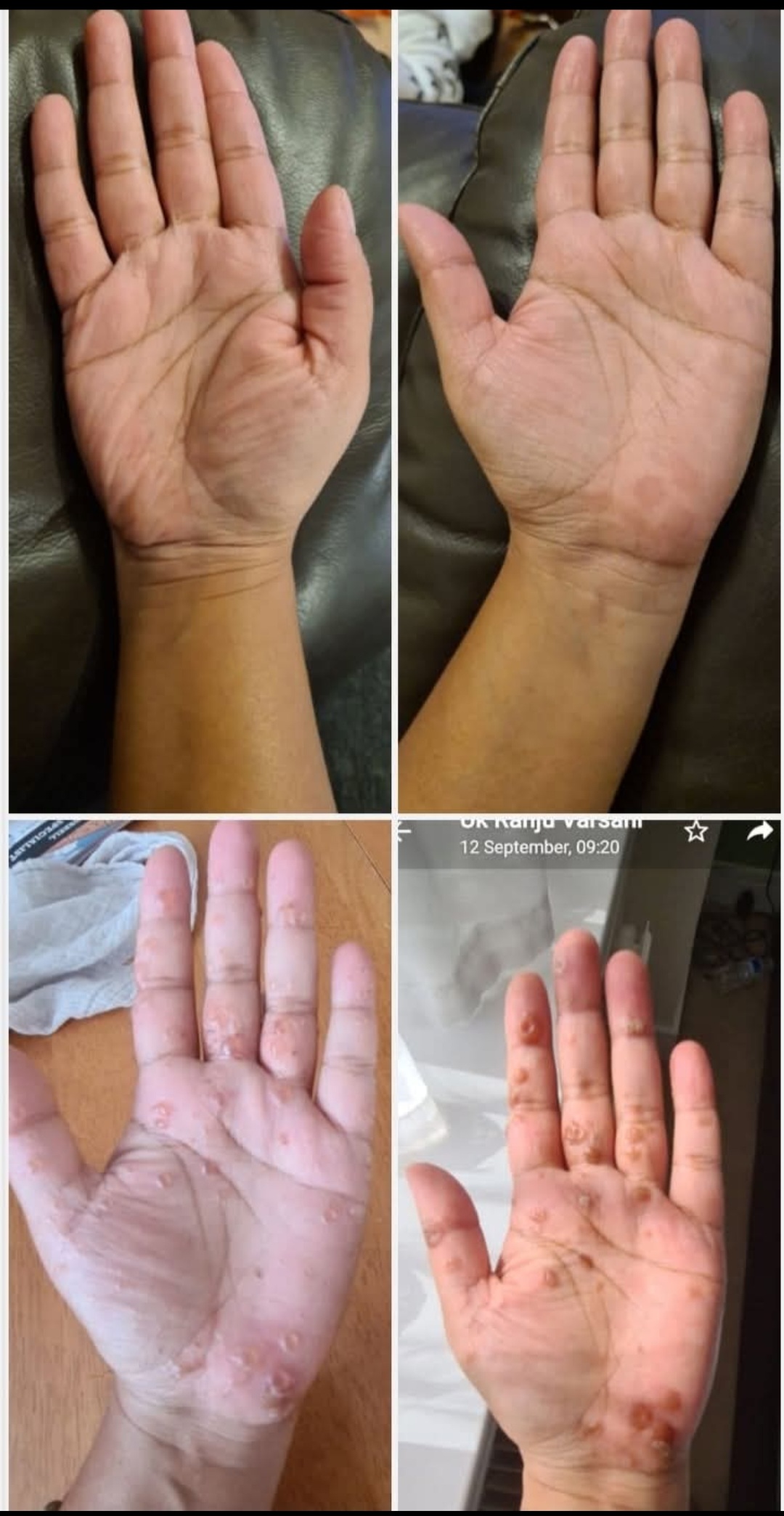 skin healed